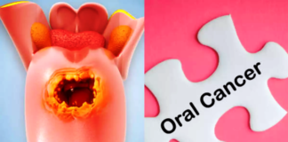 Supriya Lifescience Ltd signs agreement with Kalinga Institute of Technology for development of first-of-its-kind novel oral cancer detection kit