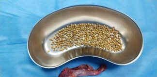 Surgical Milestone: Surgeons at Aster RV Hospitals Achieve Milestone with Removal of 345 Gallstones