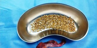 Surgical Milestone: Surgeons at Aster RV Hospitals Achieve Milestone with Removal of 345 Gallstones