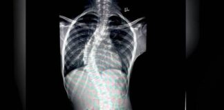 14-year-old Nigerian girl with backbone deformity successfully undergoes correction-surgery at Fortis Hospital Bannerghatta
