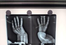 One-Year-Old with Rare Hand Deformity Treated Successfully post Complex Surgery at Fortis Escorts Faridabad